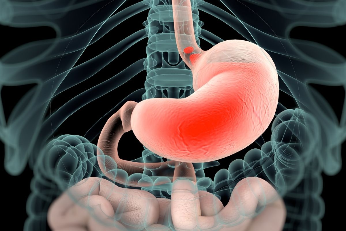 Reflux acide dans l'estomac